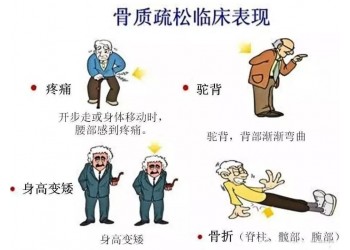 你知道骨質疏松癥對你的生活有哪些影響嗎?